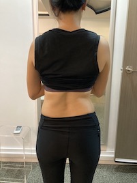 Pilates for Scoliosis
