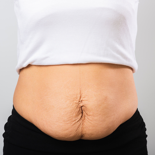 https://mt.sg/wp-content/uploads/2021/08/Diastasis-recti_resolves-mummy-tummy.jpeg